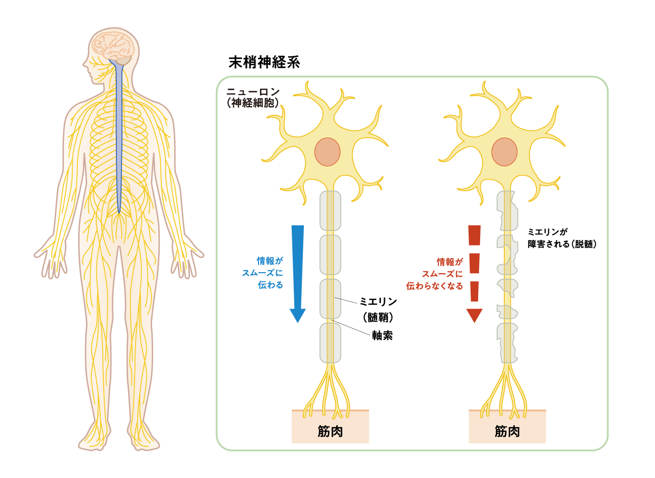 CIDPの原因(イメージ図)