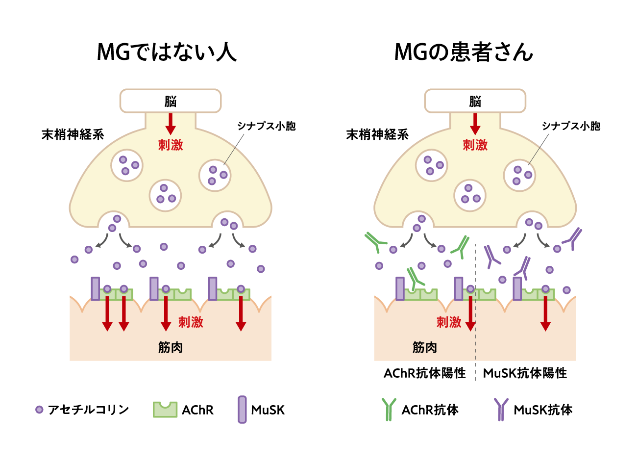 MGの原因(イメージ図)