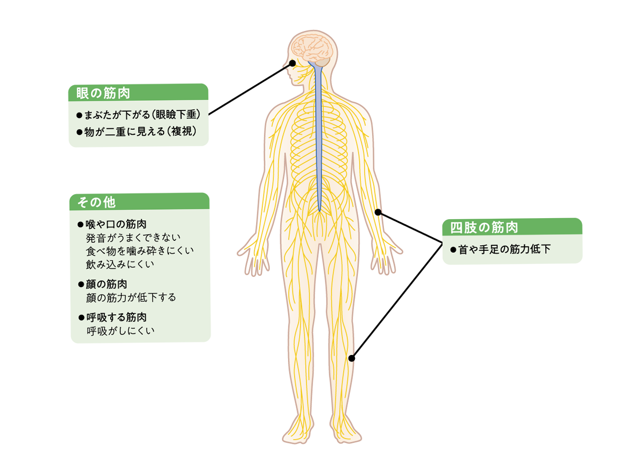 MGの症状の特徴