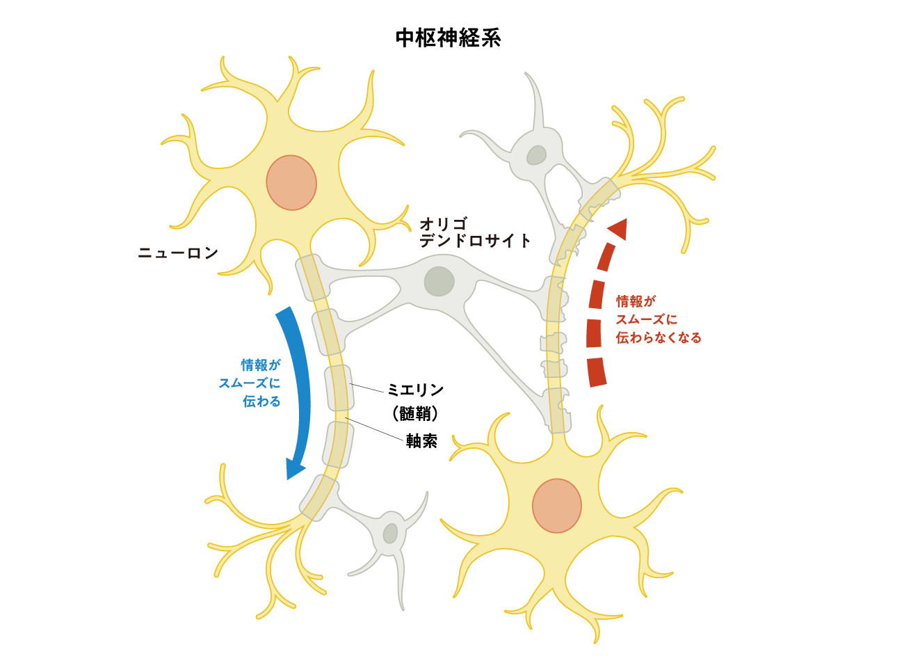MSの原因（イメージ図）