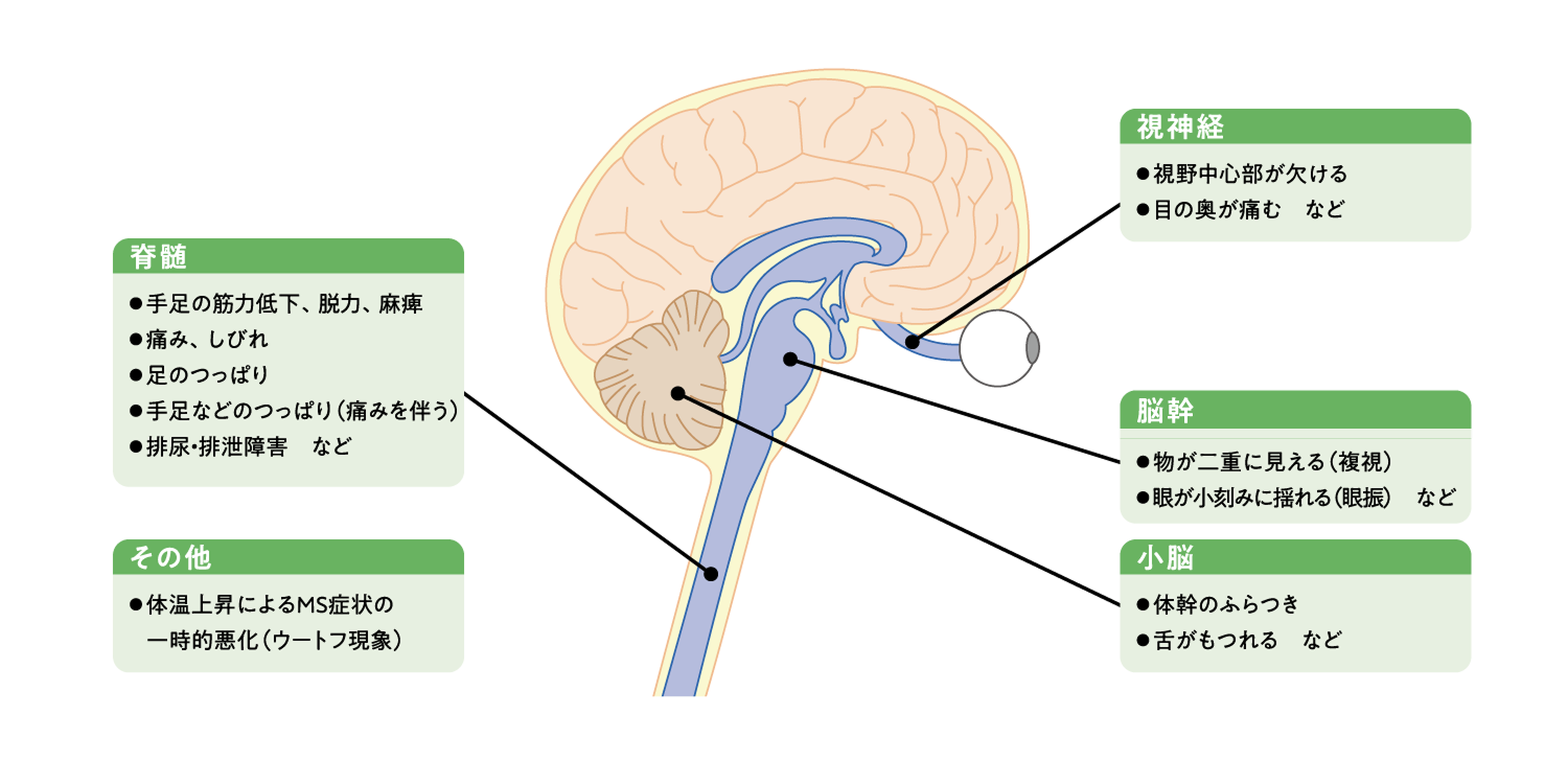 MSの症状の特徴