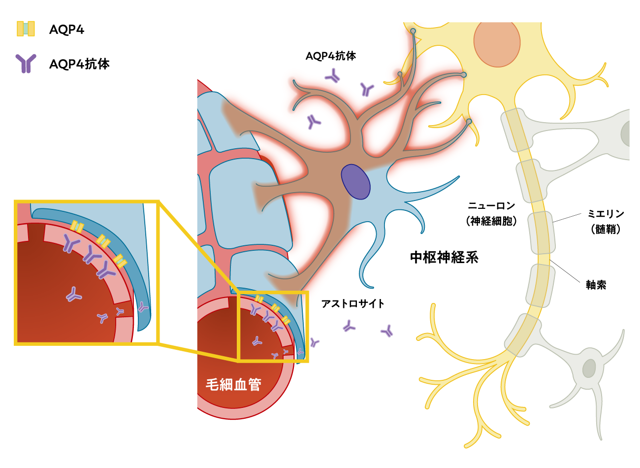 NMOSDの原因(イメージ図)